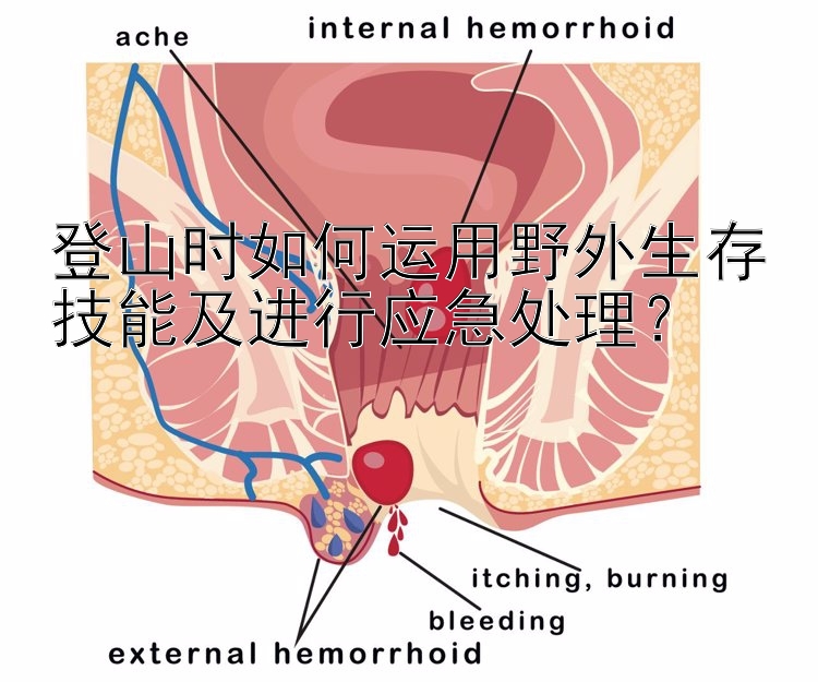 登山时如何运用野外生存技能及进行应急处理？