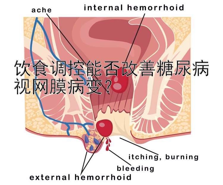 饮食调控能否改善糖尿病视网膜病变？