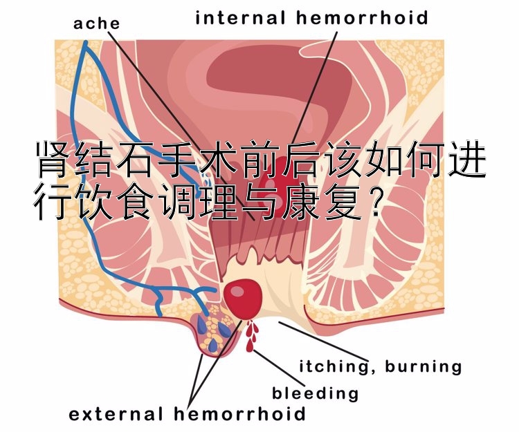 肾结石手术前后该如何进行饮食调理与康复？