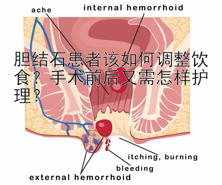 胆结石患者该如何调整饮食？手术前后又需怎样护理？